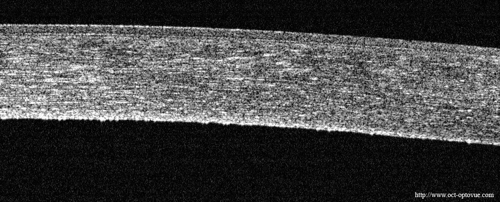 OCT cornéen d'une dystrophie de Fuchs : œdème stromal et cornea guttata endothéliale