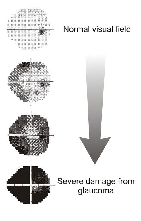 Progression d'un déficit du champ visuel dans le glaucome : scotome arciforme évoluant vers une vision tubulaire