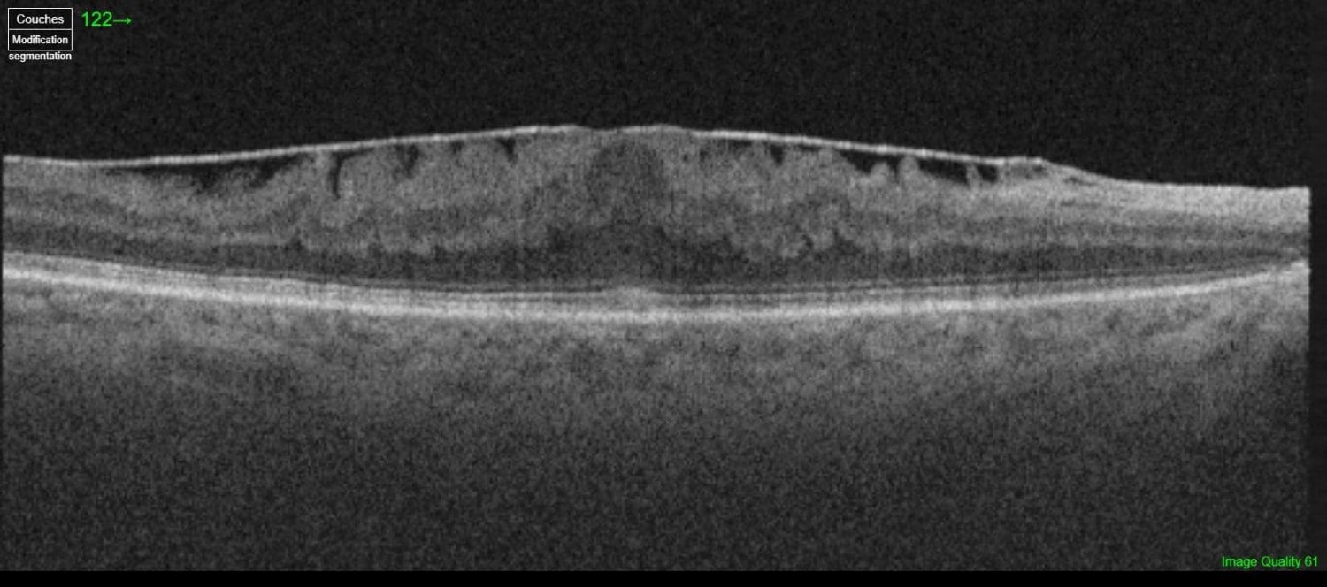 OCT maculaire : membrane épirétinienne plissant la macula
