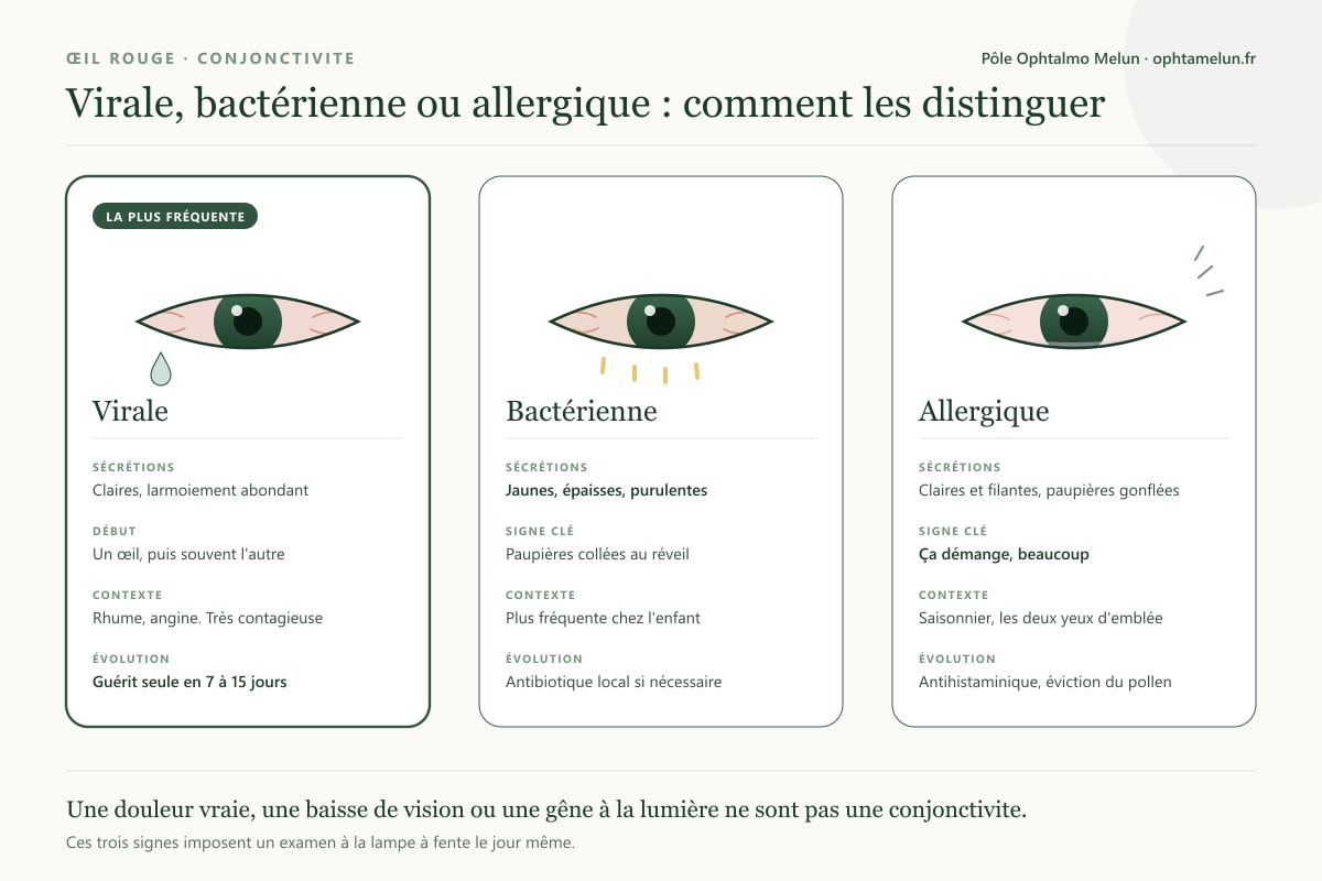 Tableau comparatif des trois conjonctivites, virale, bactérienne et allergique : aspect des sécrétions, début, contexte et évolution de chacune