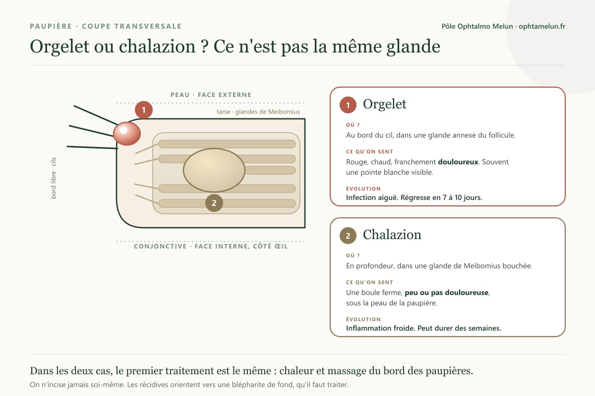 Coupe de la paupière situant l'orgelet au bord du cil et le chalazion en profondeur, dans une glande de Meibomius bouchée